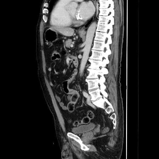 Choledocholiathiasis with normal caliber common bile duct (Radiopaedia 75368-86632 D 92).jpg