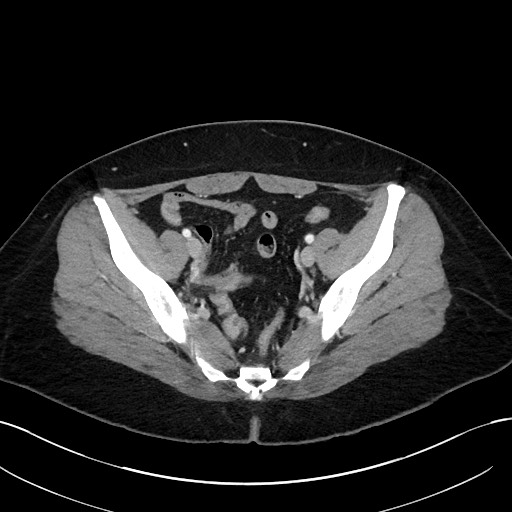 File:Choledocholithiasis after recent cholecystectomy (Radiopaedia 60929-68737 Axial 40).jpg