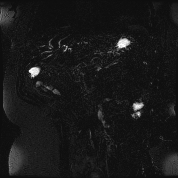 Choledocholithiasis on CT and MRI (Radiopaedia 24825-25088 Coronal T2 70).jpg