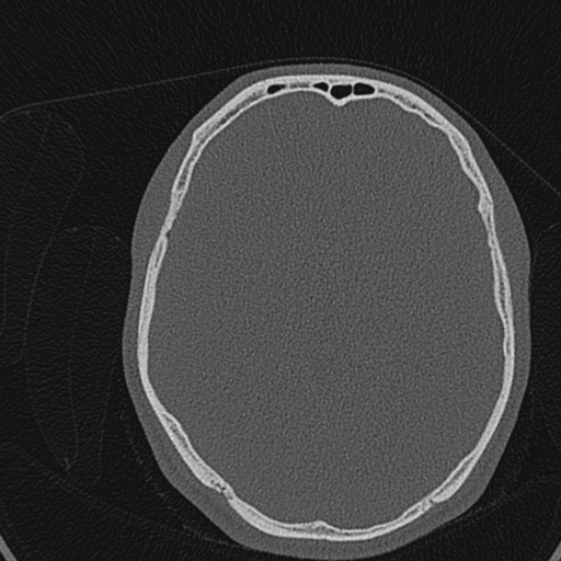 Cholesteatoma (Radiopaedia 70429-80529 Axial bone window 153).jpg