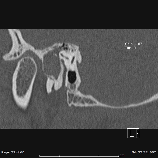 Cholesteatoma - external auditory canal (Radiopaedia 88452-105096 Sagittal bone window 32).jpg