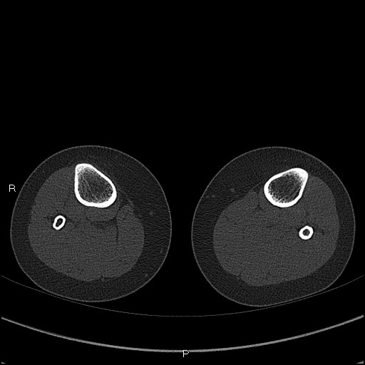 Chondroblastoma (Radiopaedia 62721-71030 Axial bone window 118).jpg