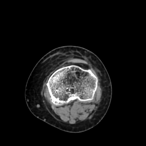 File:Chondrosarcoma - femur (Radiopaedia 64187-72954 Axial non-contrast 64).jpg