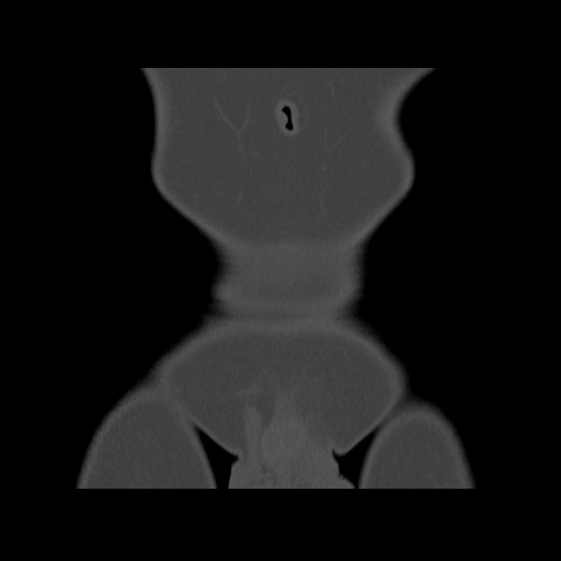 Chondrosarcoma of iliac wing (Radiopaedia 63861-72599 Coronal bone window 16).jpg