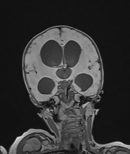 Choroid plexus papilloma (Radiopaedia 84612-100019 Coronal FLAIR 61).jpg