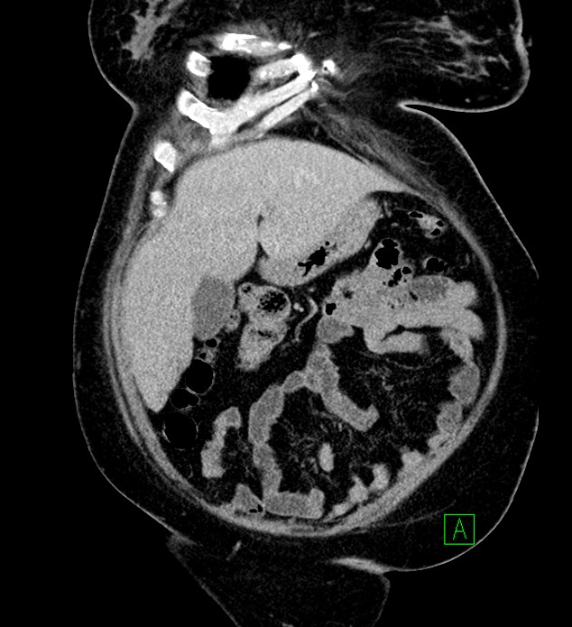 Chromophobe renal cell carcinoma (Radiopaedia 84239-99519 F 23).jpg