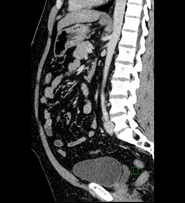 Chromophobe renal cell carcinoma (Radiopaedia 84286-99573 I 81).jpg