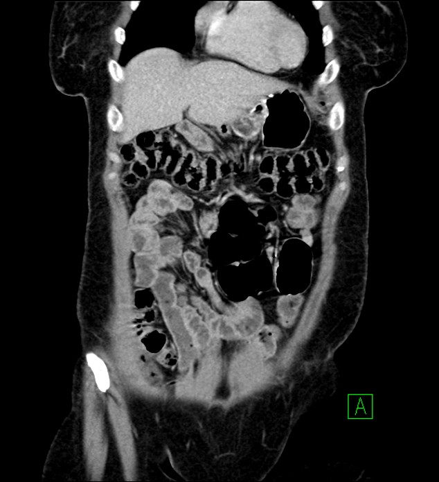 Chromophobe renal cell carcinoma (Radiopaedia 84290-99582 F 13).jpg