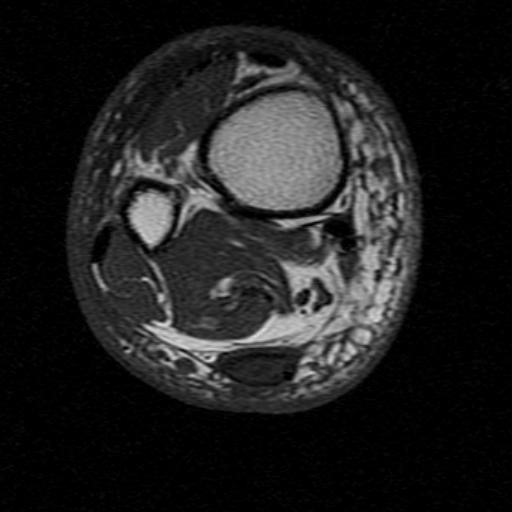File:Chronic Achilles tendon rupture (Radiopaedia 15262-15100 Axial T1 2).jpg
