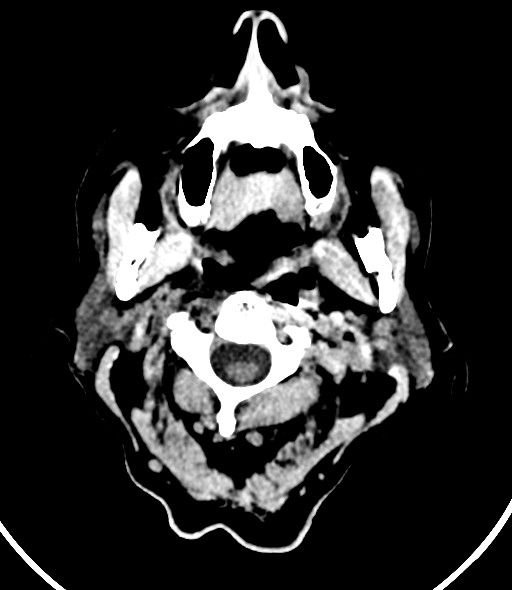 Chronic bilateral subdural hygroma (Radiopaedia 85801-101623 Axial non-contrast 63).jpg