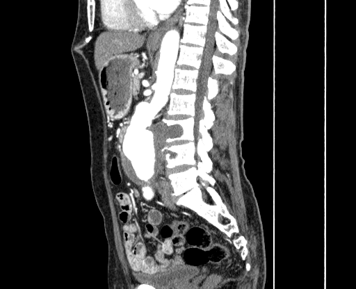 File:Chronic contained rupture of abdominal aortic aneurysm with extensive erosion of the vertebral bodies (Radiopaedia 55450-61901 B 35).jpg