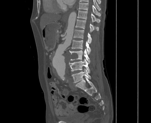 File:Chronic contained rupture of abdominal aortic aneurysm with extensive erosion of the vertebral bodies (Radiopaedia 55450-61901 Sagittal bone window 28).jpg