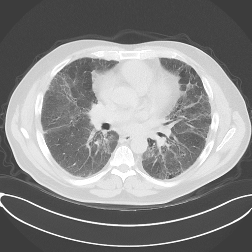 File:Chronic hypersensitivity pneumonitis (Radiopaedia 48107-52922 Axial lung window 33).png