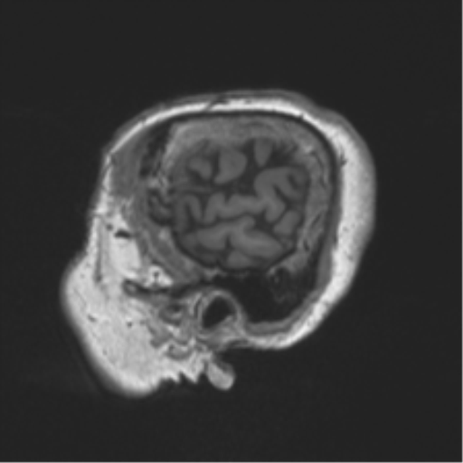 File:Chronic hypertensive encephalopathy (Radiopaedia 39993-42482 Sagittal T1 15).png