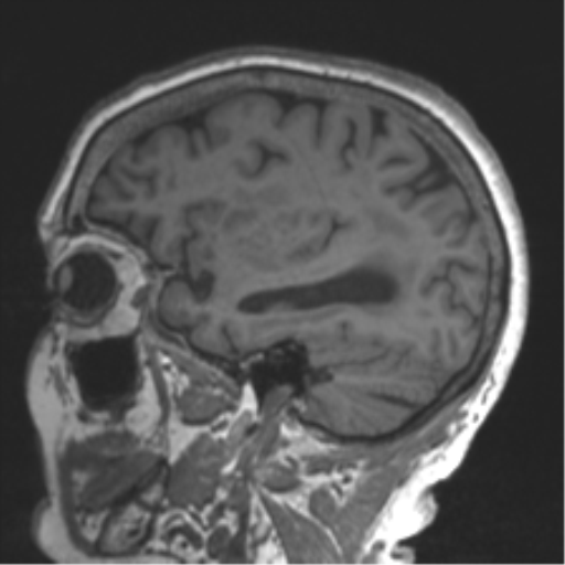 Chronic hypertensive encephalopathy (Radiopaedia 39993-42482 Sagittal T1 66).png