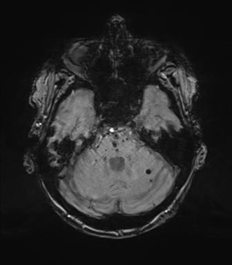 Chronic hypertensive encephalopathy (Radiopaedia 72844-83495 Axial SWI magnitude 23).png