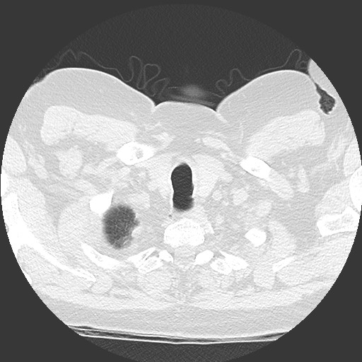 File:Chronic lung allograft dysfunction - restrictive form (Radiopaedia 60595-68316 Axial lung window 3).jpg