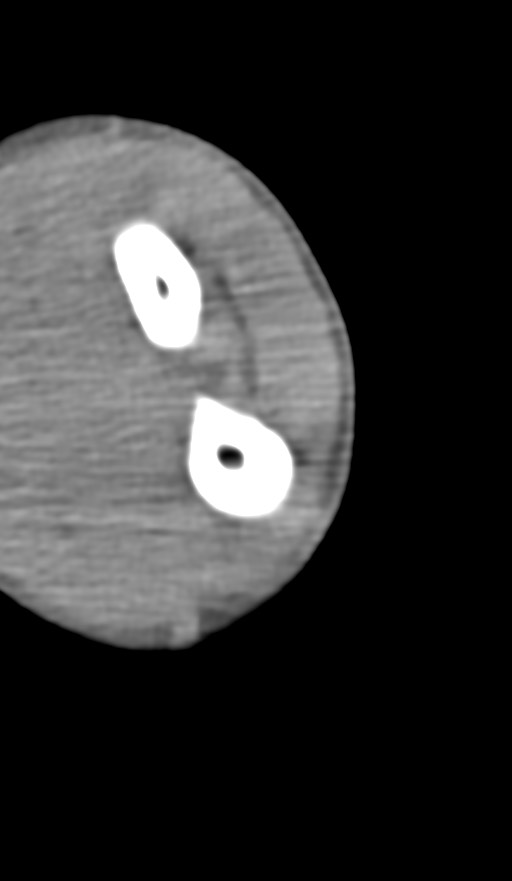 Chronic osteomyelitis of the distal humerus (Radiopaedia 78351-90971 Axial non-contrast 125).jpg