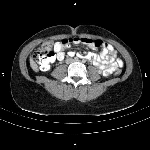File:Chronic pancreatitis (Radiopaedia 64576-73450 C 100).jpg