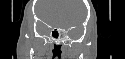 Chronic sphenoidal sinusitis (Radiopaedia 62030-70122 Coronal bone window 113).jpg