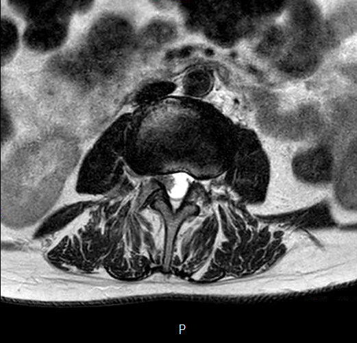 File:Chronic spinal hematoma with cauda equina syndrome (Radiopaedia 75745-87090 Axial T2 4).png