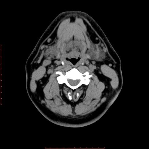 Chronic submandibular sialolithiasis (Radiopaedia 69817-79814 Axial non-contrast 123).jpg