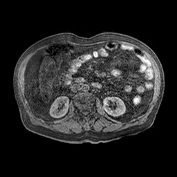 File:Cirrhosis and hepatocellular carcinoma in the setting of hemochromatosis (Radiopaedia 75394-86594 Axial T1 C+ fat sat 13).jpg