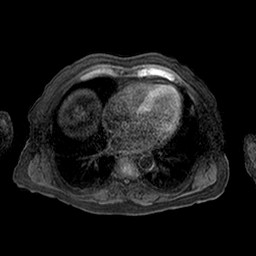 Cirrhosis and hepatocellular carcinoma in the setting of hemochromatosis (Radiopaedia 75394-86594 Axial T1 C+ fat sat 81).jpg