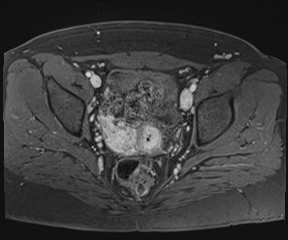 File:Class II Mullerian duct anomaly- unicornuate uterus with rudimentary horn and non-communicating cavity (Radiopaedia 39441-41755 Axial T1 fat sat 75).jpg