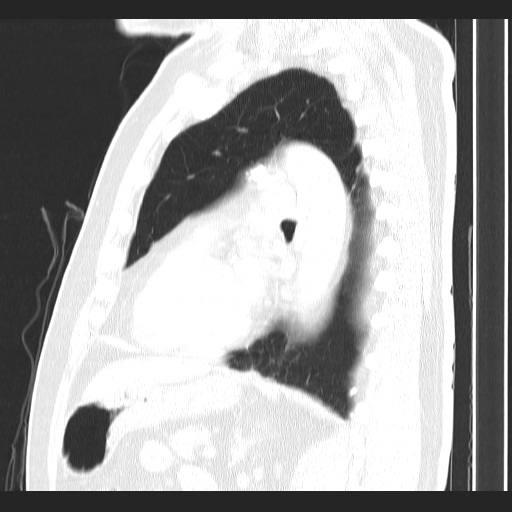 Classic complicated silicosis (Radiopaedia 49720-54961 Sagittal lung window 24).jpg