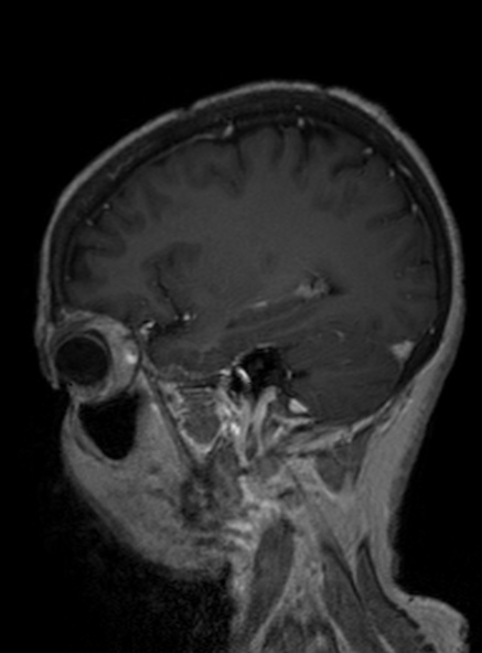 Clival meningioma (Radiopaedia 53278-59248 Sagittal T1 C+ 317).jpg