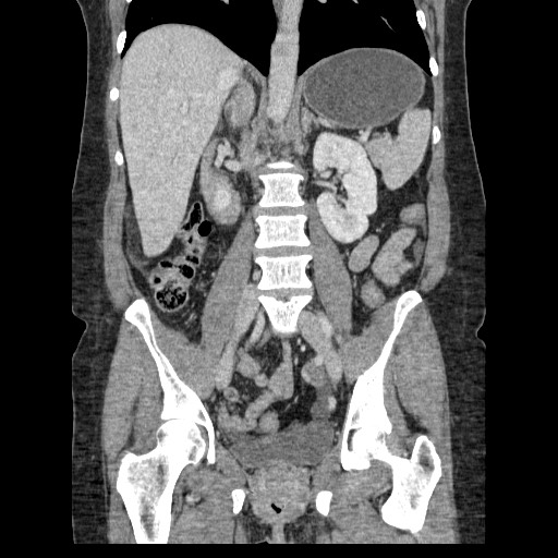 Closed loop small bowel obstruction (Radiopaedia 65403-74451 B 64).jpg