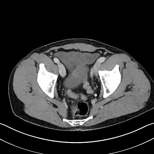 Closed loop small bowel obstruction - internal hernia (Radiopaedia 57806-64778 B 112).jpg
