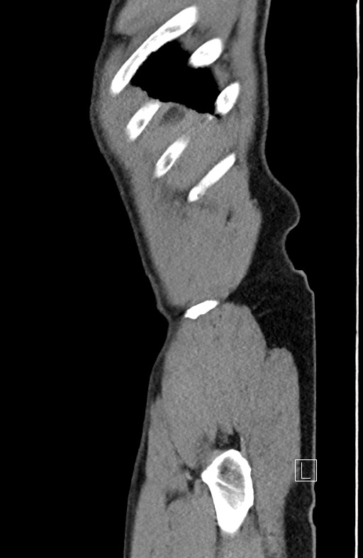 Closed loop small bowel obstruction - internal hernia (Radiopaedia 57806-64778 C 11).jpg