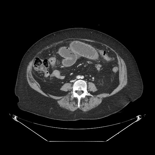 File:Closed loop small bowel obstruction - internal hernia (Radiopaedia 65402-74450 A 75).jpg