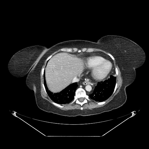 Closed loop small bowel obstruction - internal hernia (Radiopaedia 65402-74450 A 8).jpg
