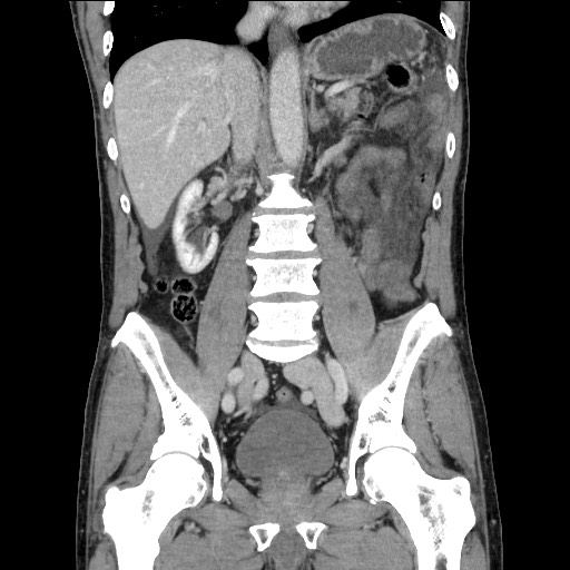 Closed loop small bowel obstruction - omental adhesion causing "internal hernia" (Radiopaedia 85129-100682 B 74).jpg