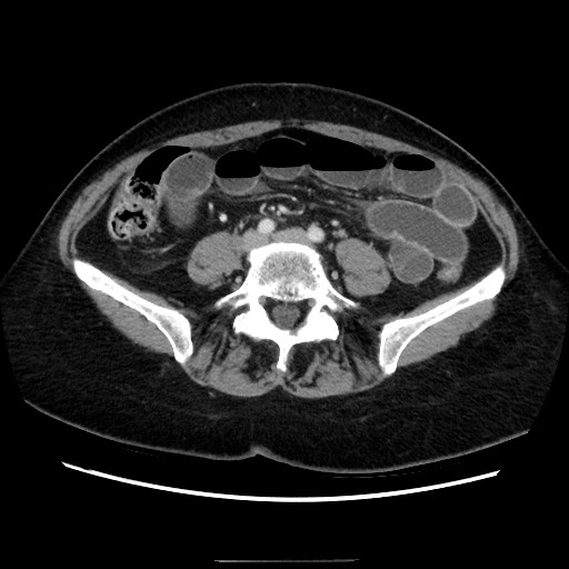 Closed loop small bowel obstruction due to adhesive bands - early and late images (Radiopaedia 83830-99015 A 108).jpg
