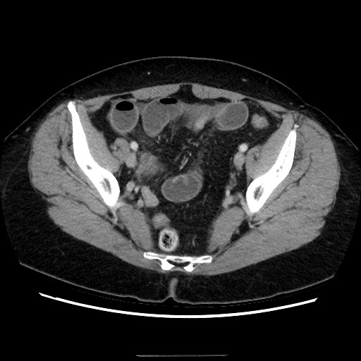 Closed loop small bowel obstruction due to adhesive bands - early and late images (Radiopaedia 83830-99015 A 137).jpg