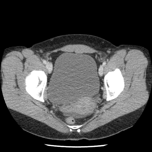 Closed loop small bowel obstruction due to trans-omental herniation (Radiopaedia 35593-37109 A 78).jpg