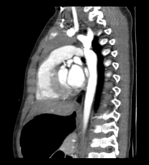 Coarctation of aorta (Radiopaedia 27427-27622 Sagittal C+ CTPA 77).png
