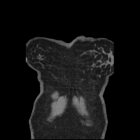 Coarctation of the aorta (Radiopaedia 67609-77010 B 65).jpg