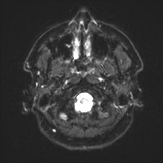 File:Cochlear incomplete partition type III associated with hypothalamic hamartoma (Radiopaedia 88756-105498 Axial DWI 2).jpg