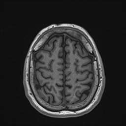 File:Cochlear incomplete partition type III associated with hypothalamic hamartoma (Radiopaedia 88756-105498 Axial T1 157).jpg