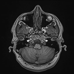 File:Cochlear incomplete partition type III associated with hypothalamic hamartoma (Radiopaedia 88756-105498 Axial T1 51).jpg