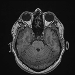 Cochlear incomplete partition type III associated with hypothalamic hamartoma (Radiopaedia 88756-105498 Axial T1 72).jpg