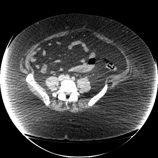File:Collection due to leak after sleeve gastrectomy (Radiopaedia 55504-61972 A 55).jpg