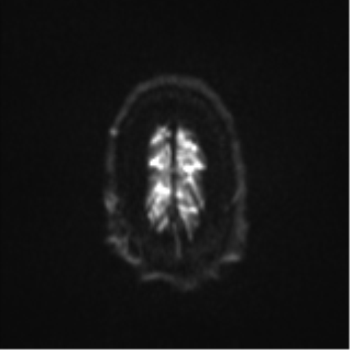 Colloid cyst (Radiopaedia 53164-59125 Axial DWI 27).png