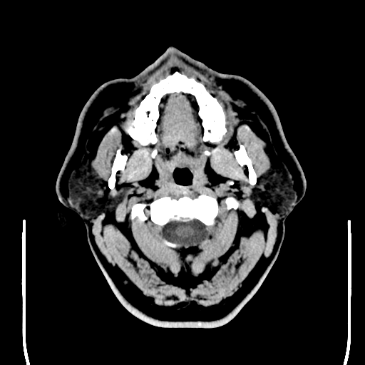 File:Colloid cyst (large) (Radiopaedia 34415-35734 Axial non-contrast 2).png