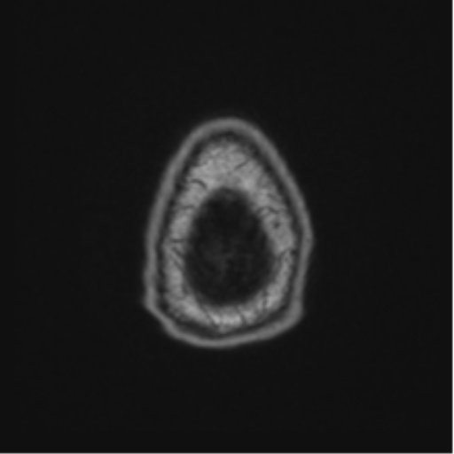 File:Colloid cyst of the third ventricle (Radiopaedia 86571-102662 Axial T1 75).png